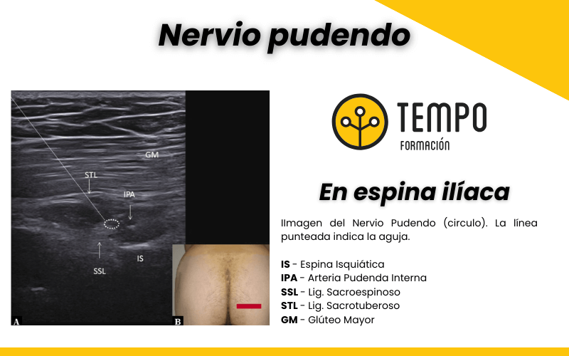 Nervio Pudendo Y Ecografía Tempo Formación